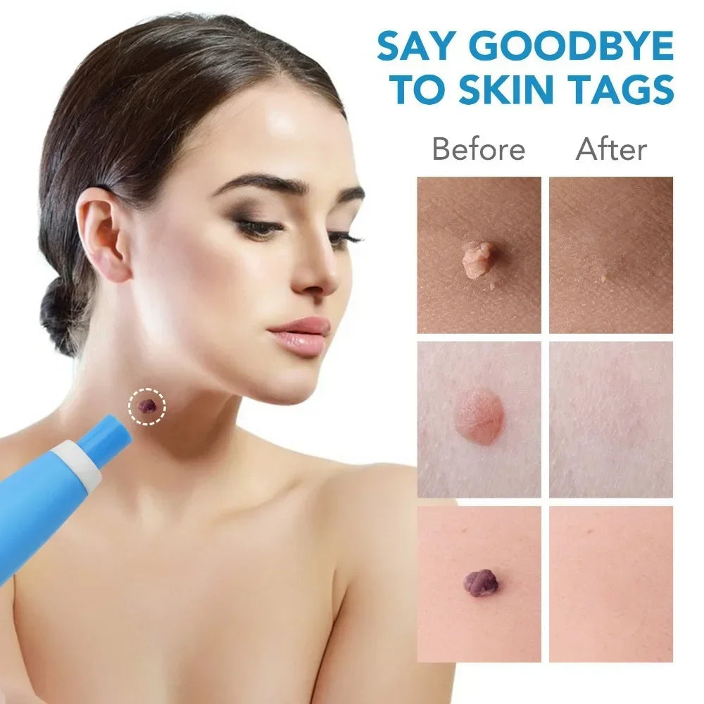 2-In-1 Painless Auto Skin Tag Mole Wart Removal Kit Cleaning Tools Face Skin Care Body Wart Dot Treatments Remover Beauty Health